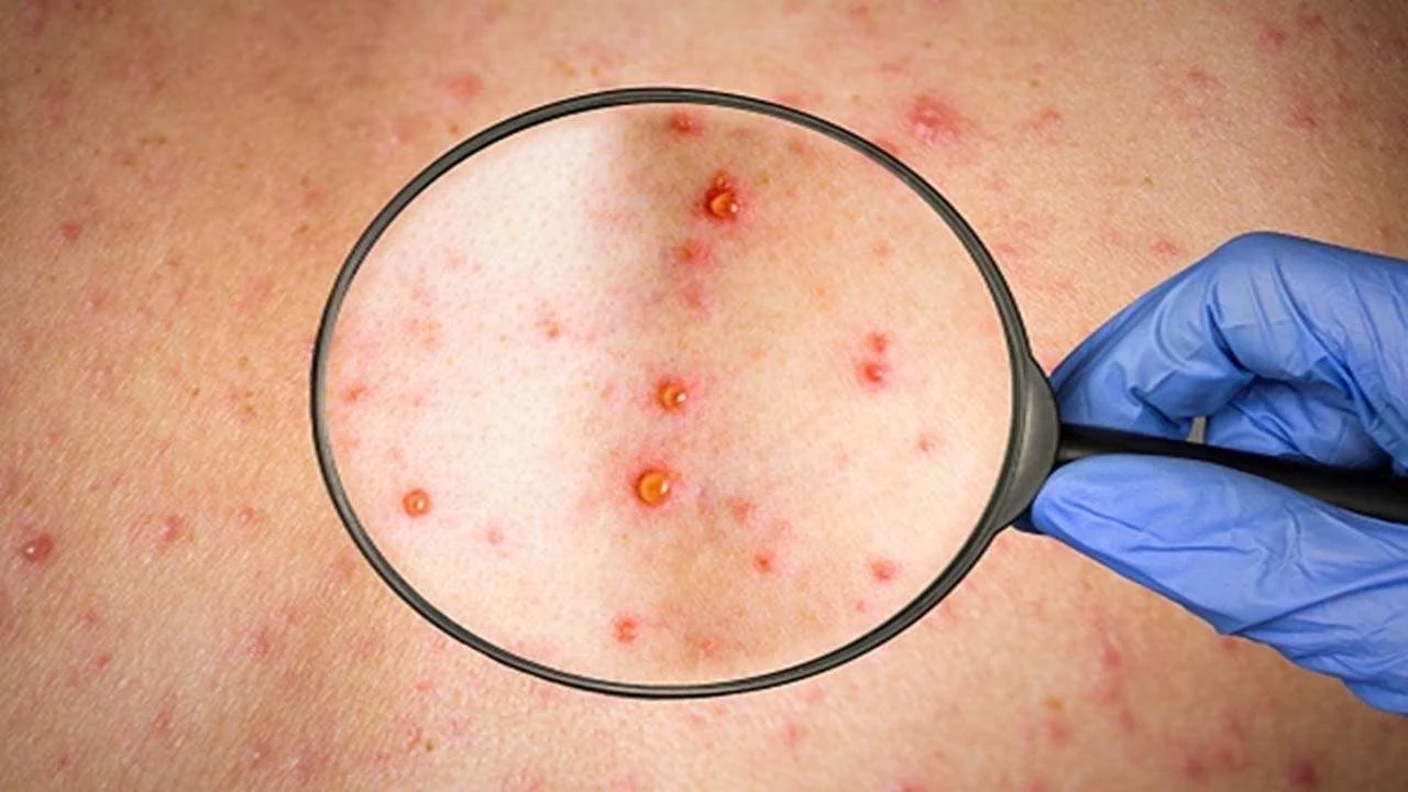 PARÁ REGISTRA 19 CASOS DE MPOX, INFORMAM AUTORIDADES DE SAÚDE