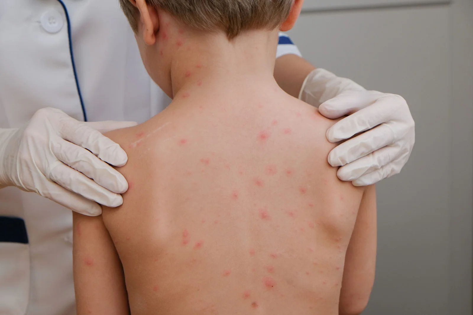 ENTENDA AS DIFERENÇAS ENTRE MPOX E SARAMPO PARA EVITAR CONFUSÕES PERIGOSAS