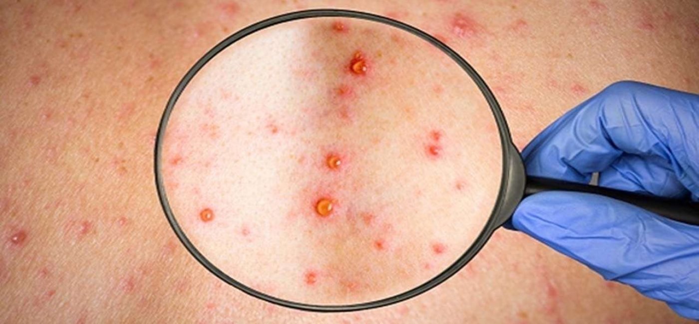 19 casos de MPOX no Pará